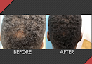 Your hair transplant and cost Maxim Hair Restoration in Chicago in IL