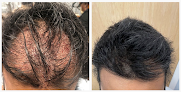 Your hair transplant and cost Md Hair Transplant in Germantown in Maryland