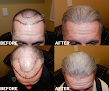 Your hair transplant and cost Medical Hair Transplant & Aesthetics in Los Gatos in Santa Clara