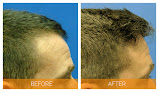 Your hair transplant and cost Memphis Hair Doctor in Germantown in Tennessee