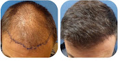 Your hair transplant and cost Meshkin Medical in Newport Beach in California