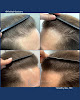 Your hair transplant and cost Miami Hair Institute in Miami in FL
