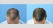 Your hair transplant and cost Michael Wolfeld, Md | Wolfeld Hair Restoration New York in New York in New York