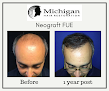 Your hair transplant and cost Michigan Hair Restoration: Sterling Heights in Sterling Heights in Michigan