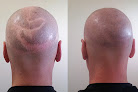 Your hair transplant and cost Microaesthetics in Boston in Massachusetts