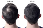 Your hair transplant and cost Mind & Body Rejuvenation Clinic For Weight Loss in Temecula in California