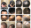 Your hair transplant and cost Mink in Albuquerque in New Mexico