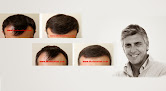 Your hair transplant and cost Modena Hair Transplant Institute in Corona Del Mar in Orange