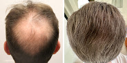 Your hair transplant and cost Modena Hair Transplant Institute in Henderson in Clark