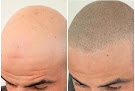 Your hair transplant and cost Modere Scalp Micropigmentation in Vernon Hills in IL