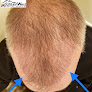 Your hair transplant and cost Mountain West Medical Services in Meridian in Idaho