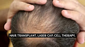 Your hair transplant and cost My Hair Md in Oceanside in California