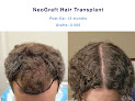 Your hair transplant and cost Nashville Hair Doctor in Brentwood in Tennessee
