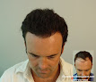 Your hair transplant and cost Natural Hair Transplant Medical Center in Newport Beach in Orange