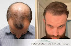 Your hair transplant and cost Natural Transplants, Hair Restoration Clinic in Miami in Florida