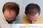 Your hair transplant and cost Natural Transplants, Hair Restoration Clinic in Towson in Maryland
