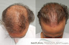 Your hair transplant and cost Natural Transplants, Hair Restoration Clinic in Bethesda in Maryland