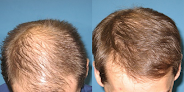 Your hair transplant and cost New England Associates in Manchester in New Hampshire