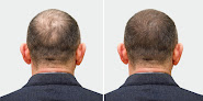 Your hair transplant and cost New England Center For Hair Restoration in Westwood in Massachusetts