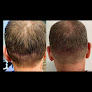 Your hair transplant and cost New Level Aesthetics in Charlotte in North Carolina