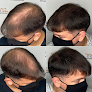 Your hair transplant and cost New Life Scalp in Long Island City in New York