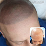 Your hair transplant and cost Nj Scalp Micropigmentation & New Jersey Smp in Turnersville in New Jersey