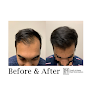 Your hair transplant and cost North Atlanta Hair Restoration in Alpharetta in Georgia