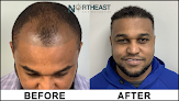 Your hair transplant and cost Northeast Hair Restoration in Wellesley in Massachusetts