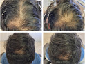 Your hair transplant and cost Nova Hair And Skin Clinic in Fairfax in Virginia