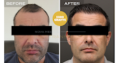 Your hair transplant and cost Nova Medical Hair Transplant in New York in New York