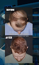 Your hair transplant and cost Nova Medical in Chicago in IL