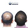 Your hair transplant and cost Nuhair Hair Restoration Clinic in Hato Rey in Puerto Rico