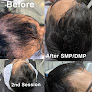 Your hair transplant and cost Nuhair Ink Scalp Micro Pigmentation in Sacramento in California