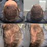 Your hair transplant and cost Nuhair Ink Scalp Micropigmentation in Roseville in California