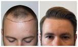 Your hair transplant and cost Oakland Hills Hair | Hair Transplant & Restoration In Michigan in Auburn Hills in Michigan
