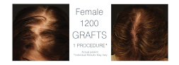 Your hair transplant and cost Ohio Hair Restoration in Dublin in Ohio