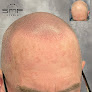 Your hair transplant and cost Ohio Smp Studio in Mansfield in Ohio