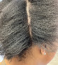 Your hair transplant and cost Ology: Hair Loss And Restoration in Upper Darby Township in Pennsylvania