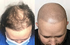 Your hair transplant and cost Oracle Smp | Scalp Micropigmentation Studio in Metairie in Louisiana