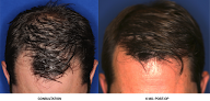Your hair transplant and cost Orange County Hair Restoration in Irvine in California