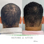Your hair transplant and cost Orlando Hair Clinic in Orlando in Florida