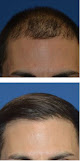 Your hair transplant and cost Pacific Hair Center- San Diego Hair Transplant in San Diego in California
