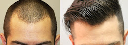 Your hair transplant and cost Pacific Northwest Hair Restoration in Tigard in Oregon