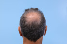 Your hair transplant and cost Parsa Mohebi Hair Restoration in Beverly Hills in California
