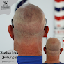Your hair transplant and cost Permanent Precision Scalp Micro Pigmentation in Scottsdale in Maricopa