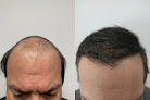 Your hair transplant and cost Philadelphia Hair Restoration in Bala Cynwyd in Pennsylvania