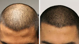 Your hair transplant and cost Phoenix Hair Restoration & Aesthetics in Duluth in Georgia