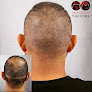 Your hair transplant and cost Pittsburgh International Hairlines in Oakdale in Pennsylvania