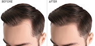 Your hair transplant and cost Plasmamedica Hair Transplant Istanbul Turkey in Chicago in IL