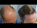 Your hair transplant and cost Plasmamedica Hair Transplant Istanbul Turkey in Oak Brook in IL